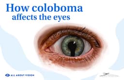 Coloboma: What It Is & How It Affects Your Eyes