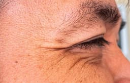 Lagophthalmos: Causes, symptoms and treatment