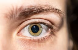 Mydriasis: Definition, Causes, Treatment