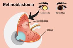Retinoblastoma: Symptoms, Causes, Treatments