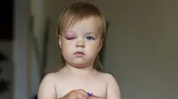 Periorbital Cellulitis