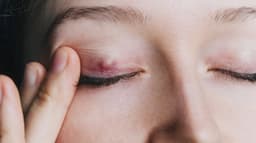What Is a Chalazion (Bump on Eyelid)?