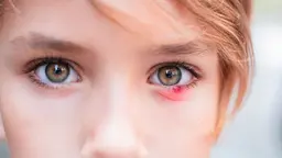 Stye (Sty or Hordeolum): Causes, Symptoms and Home Remedies