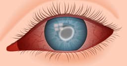 Acanthamoeba Keratitis: Eyes Hurt After Taking Out Your Contacts?