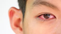 Cogan’s Syndrome: Symptoms and Treatments