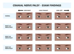 Cranial Nerve Palsy – CN III, IV, VI & VII Palsy