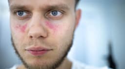 How Lupus Affects the Eyes