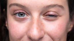 What is Ocular Myasthenia Gravis?