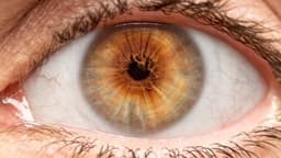 Polycoria: Causes, Symptoms & Treatments