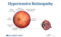 What Is Hypertensive Retinopathy?