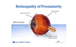 Retinopathy of Prematurity: A Real Life Story