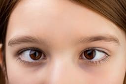 What Is Hypertropia?