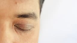 Why Do I Have Dry Skin on My Eyelid?