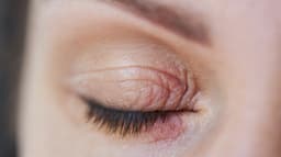 Eyelid Inflammation