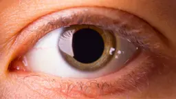 Blown Pupil